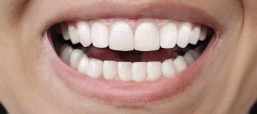 Prime Dental Clear aligners after